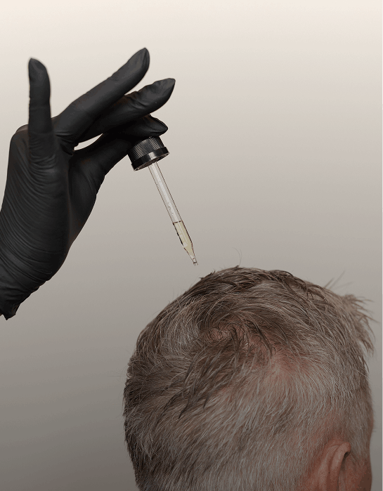 minoxidil for hair loss