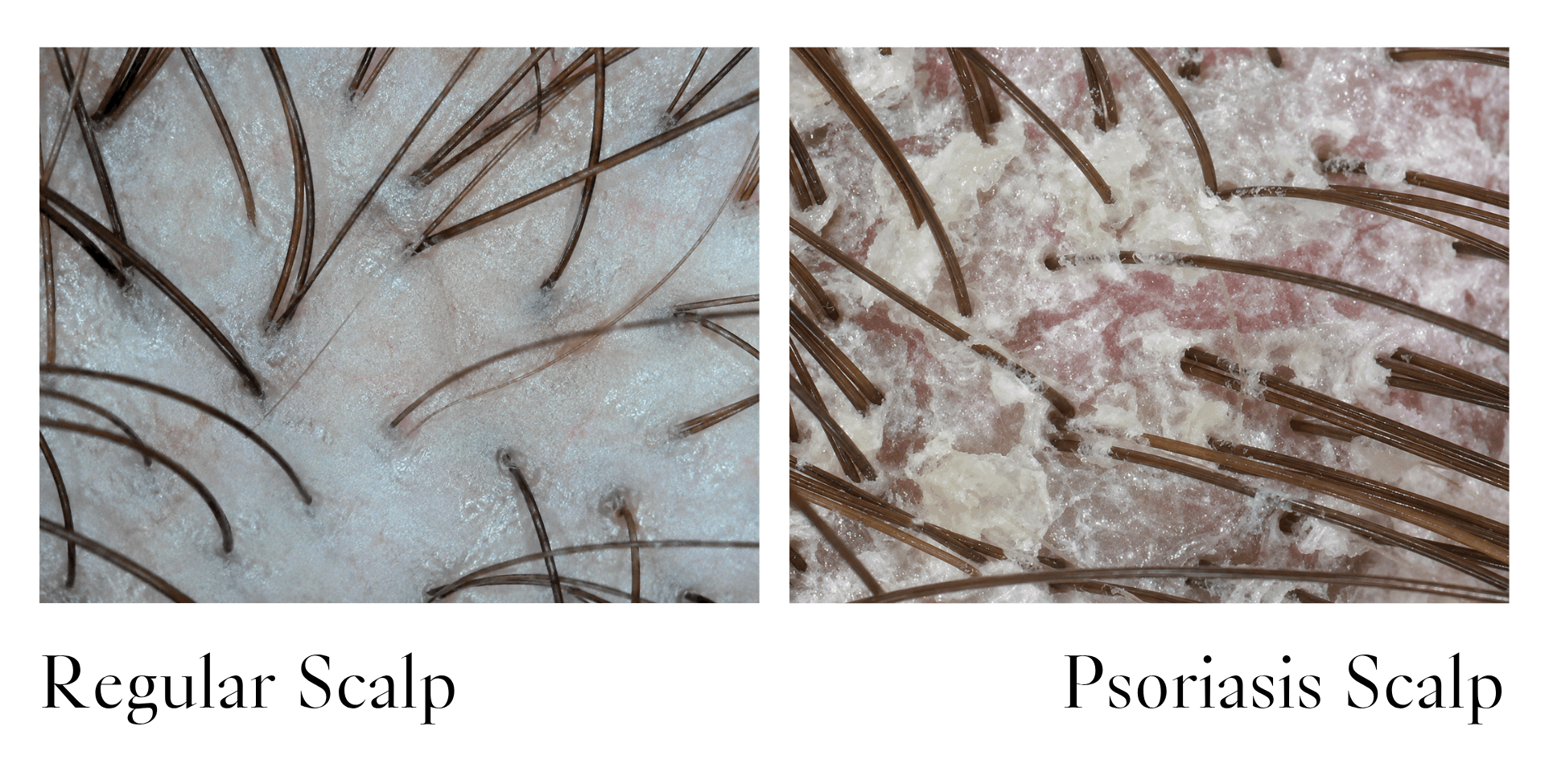 a healthy scalp vs scalp psoriasis