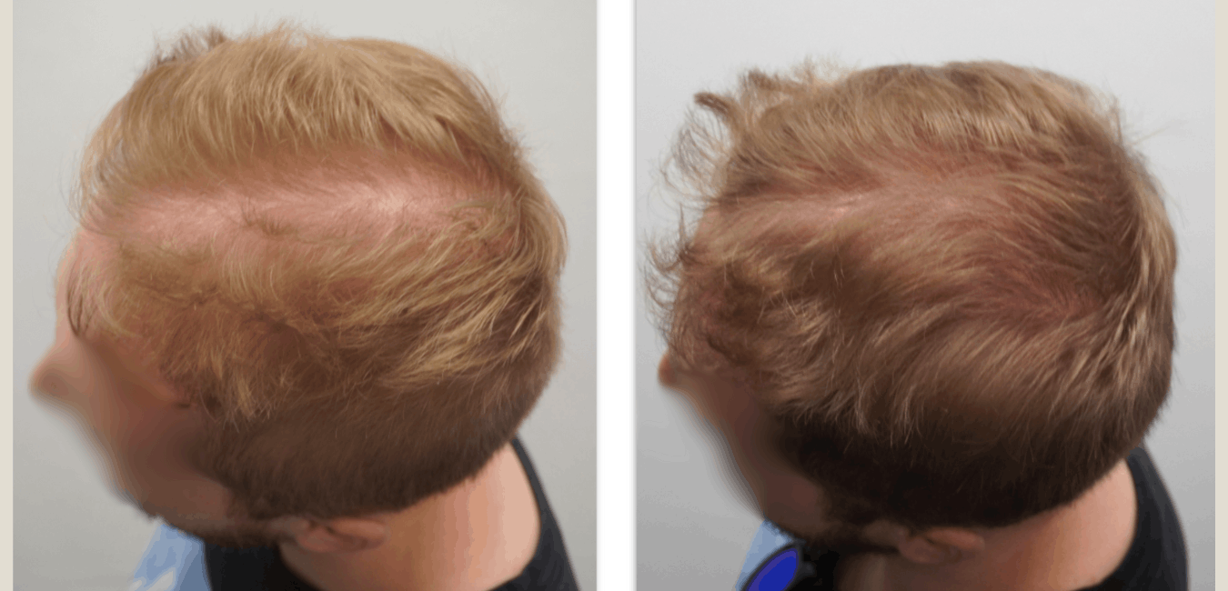 non surgical hair loss treatments for men before and after