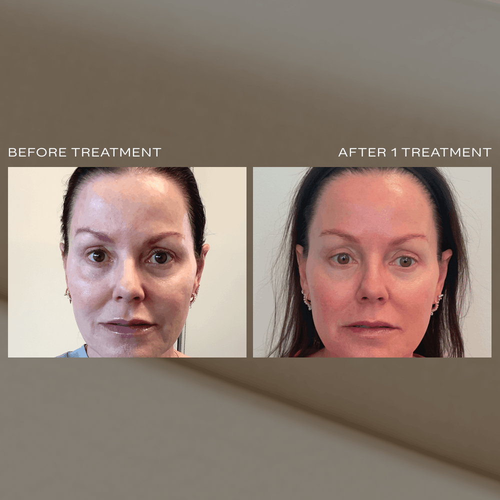 Laser Skin Resurfacing Scottsdale Phoenix.png