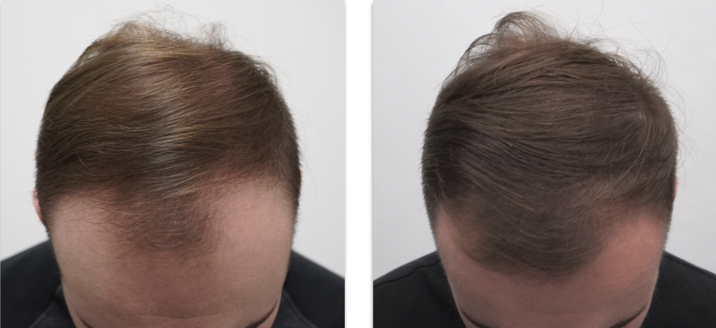 before and after propecia use male