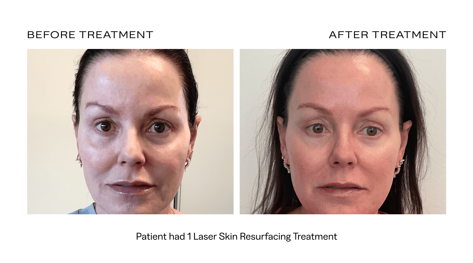 before after laser resurfacing scottsdale