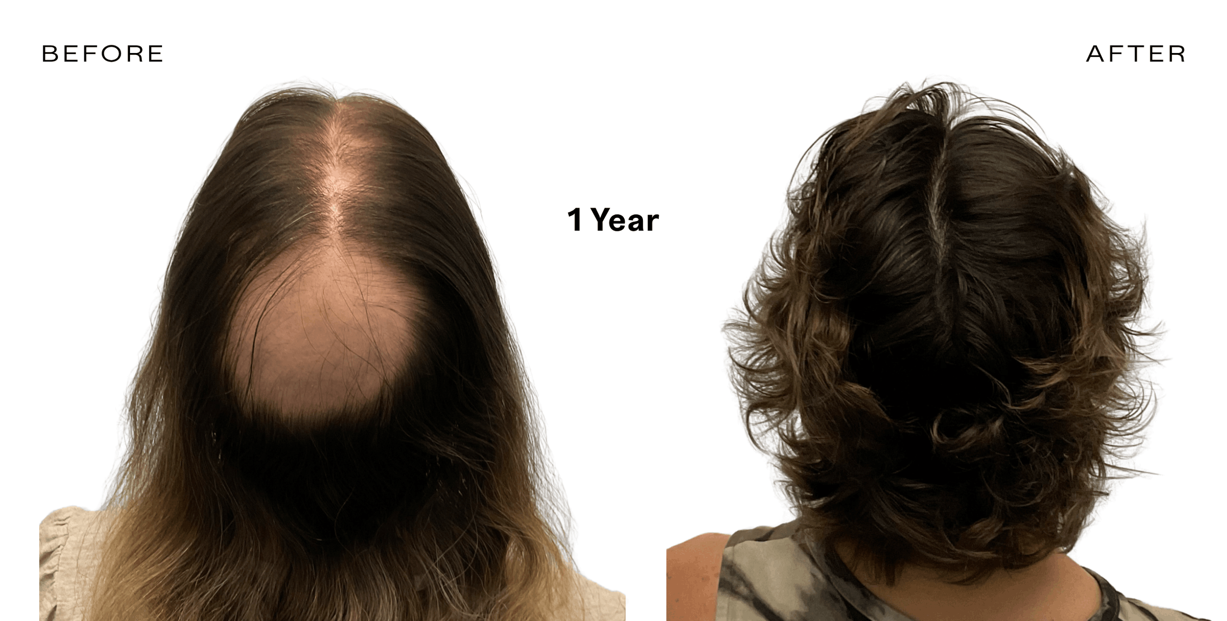 exosome therapy for hair loss
