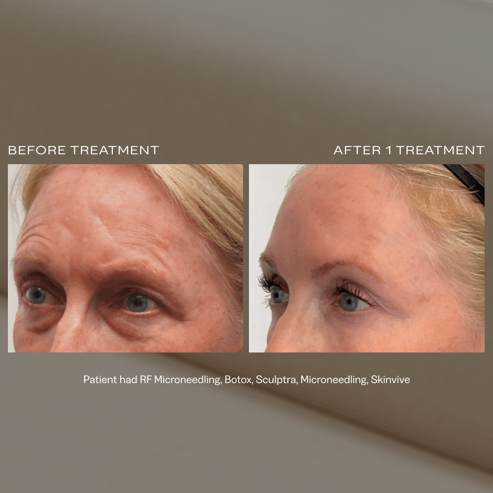 RF Microneedling Scottsdale and Phoenix.png