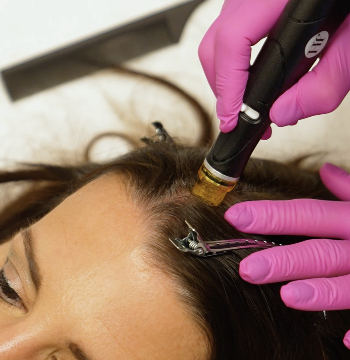 scalp vacuum treatment