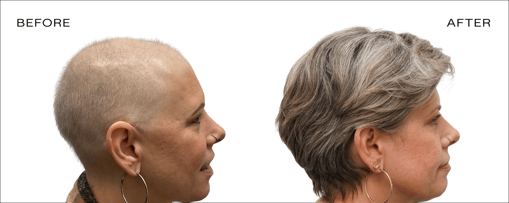 before and after hair loss trichologist