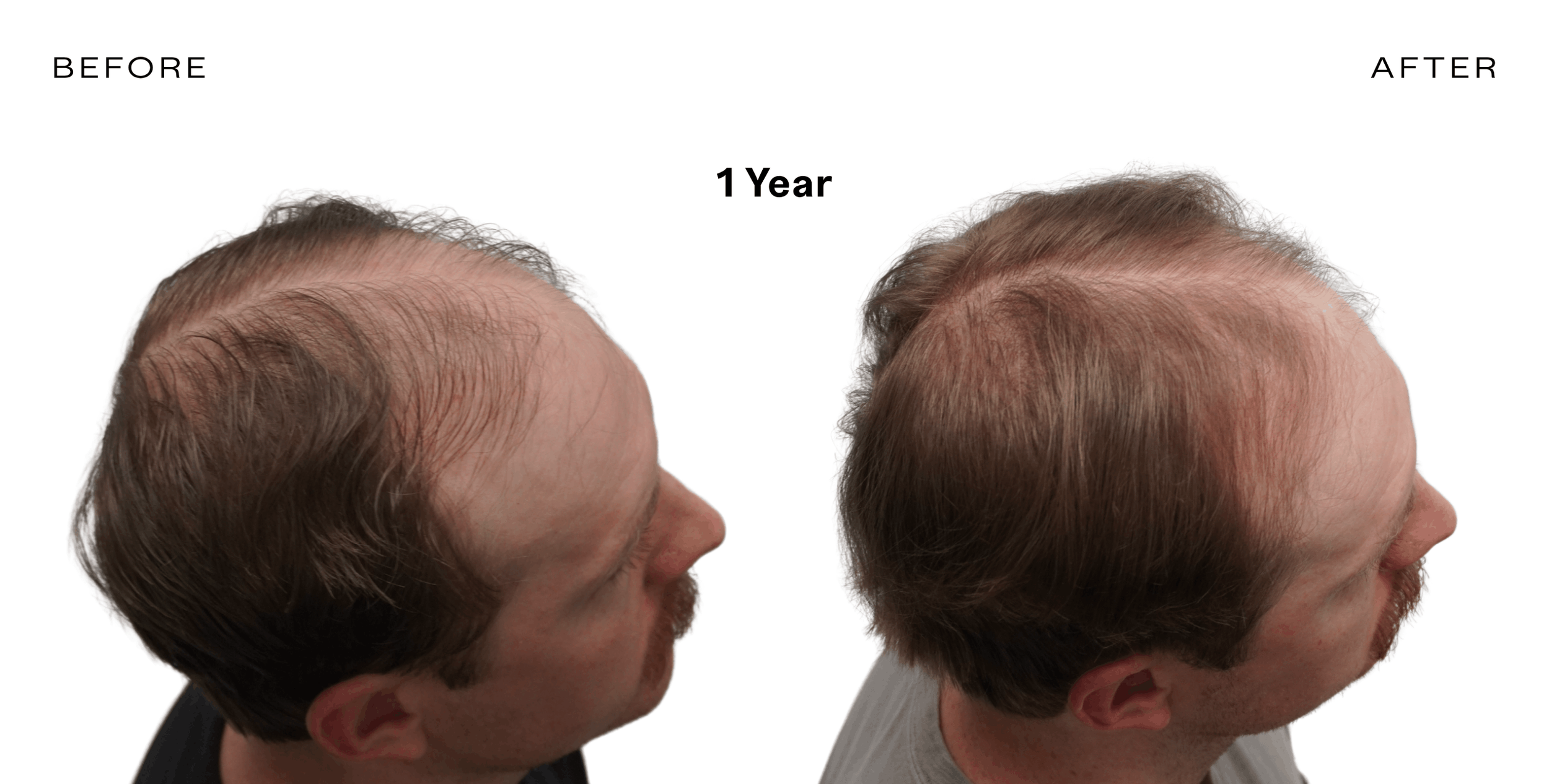 exosome therapy for hair loss