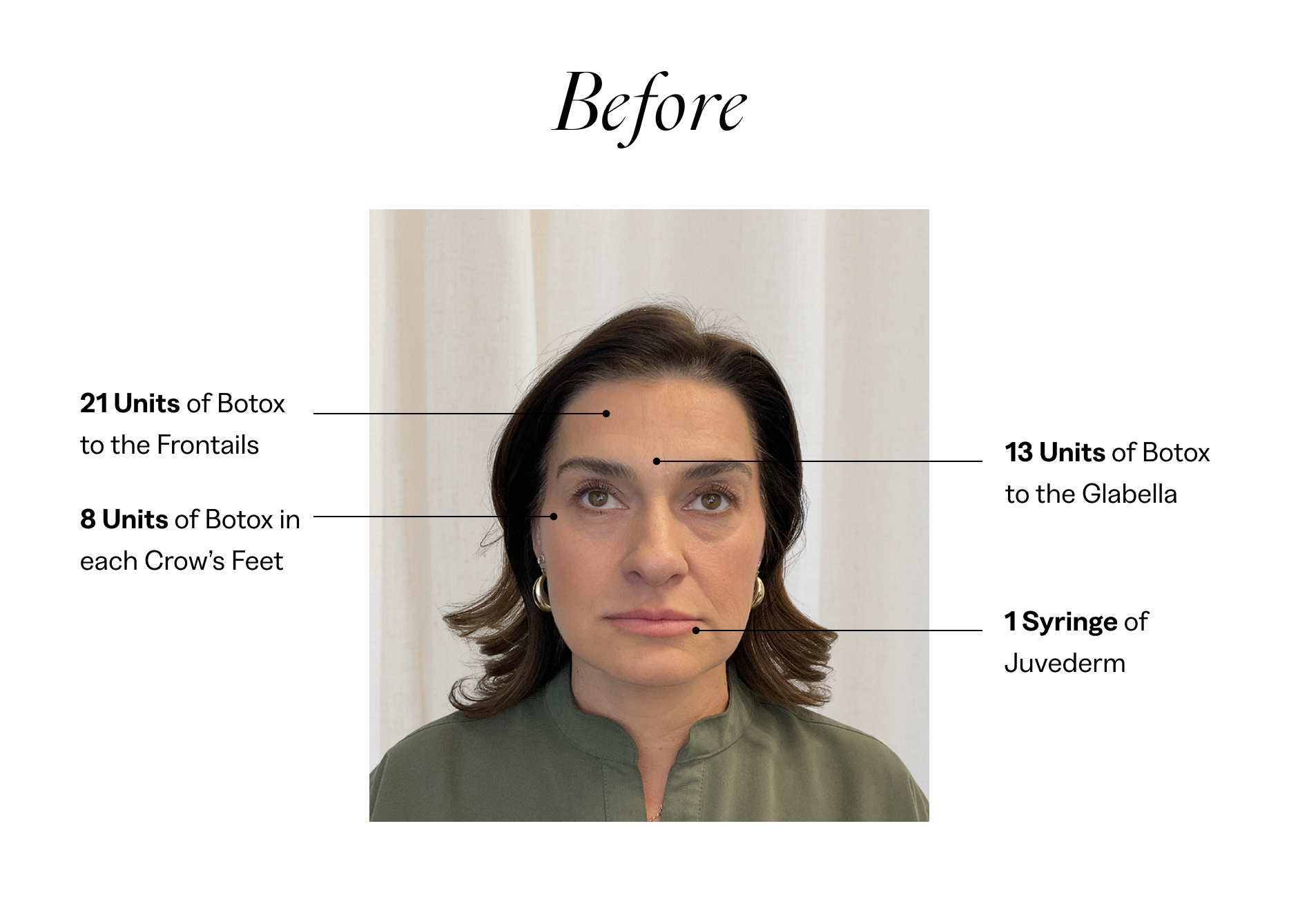 botox injector scottsdale