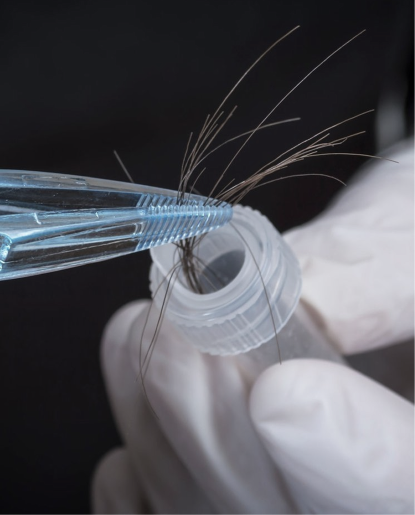 someone doing a hair follicle test for a hair restoration treatment in the larger phoenix area at NHLMA