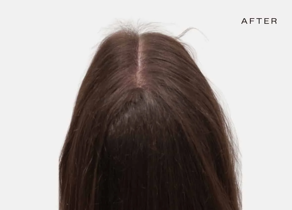 female hair loss treatment before and after