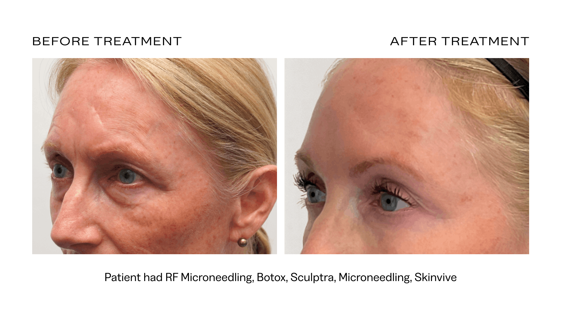 before after rf microneedling scottsdale