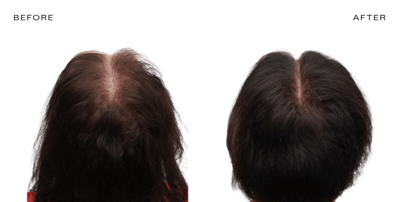 a woman's before and after hair loss transformation using exosome therapy at nhlma in scottsdale