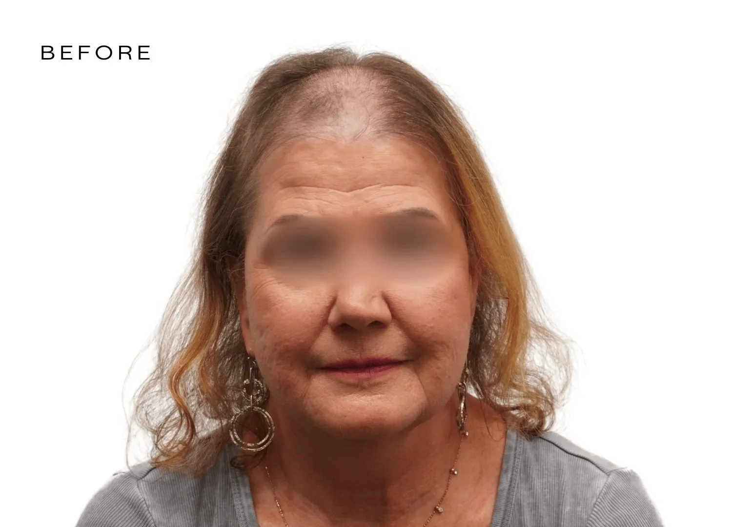 advanced hair loss treatment