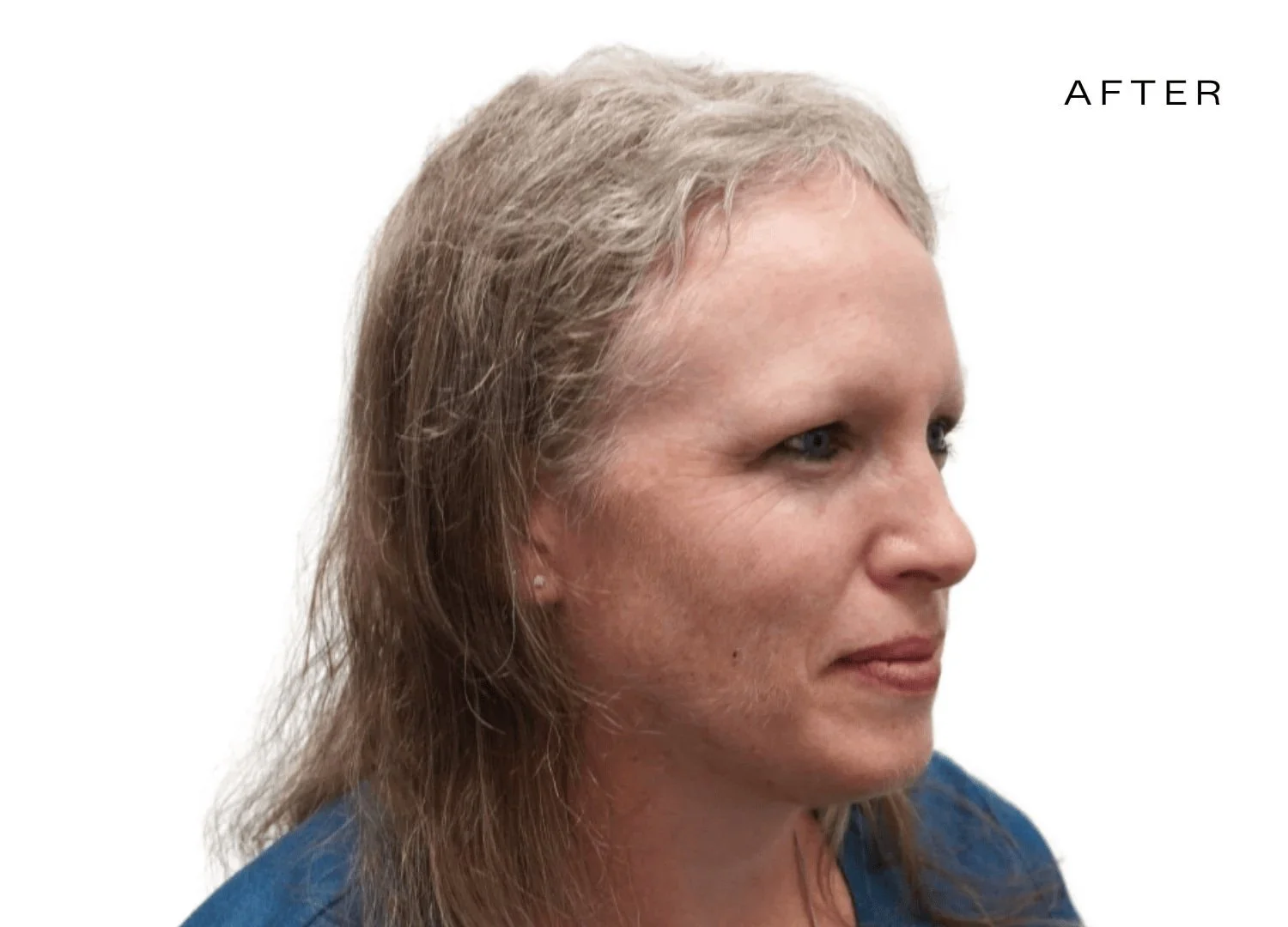 female hair regrowth before and after