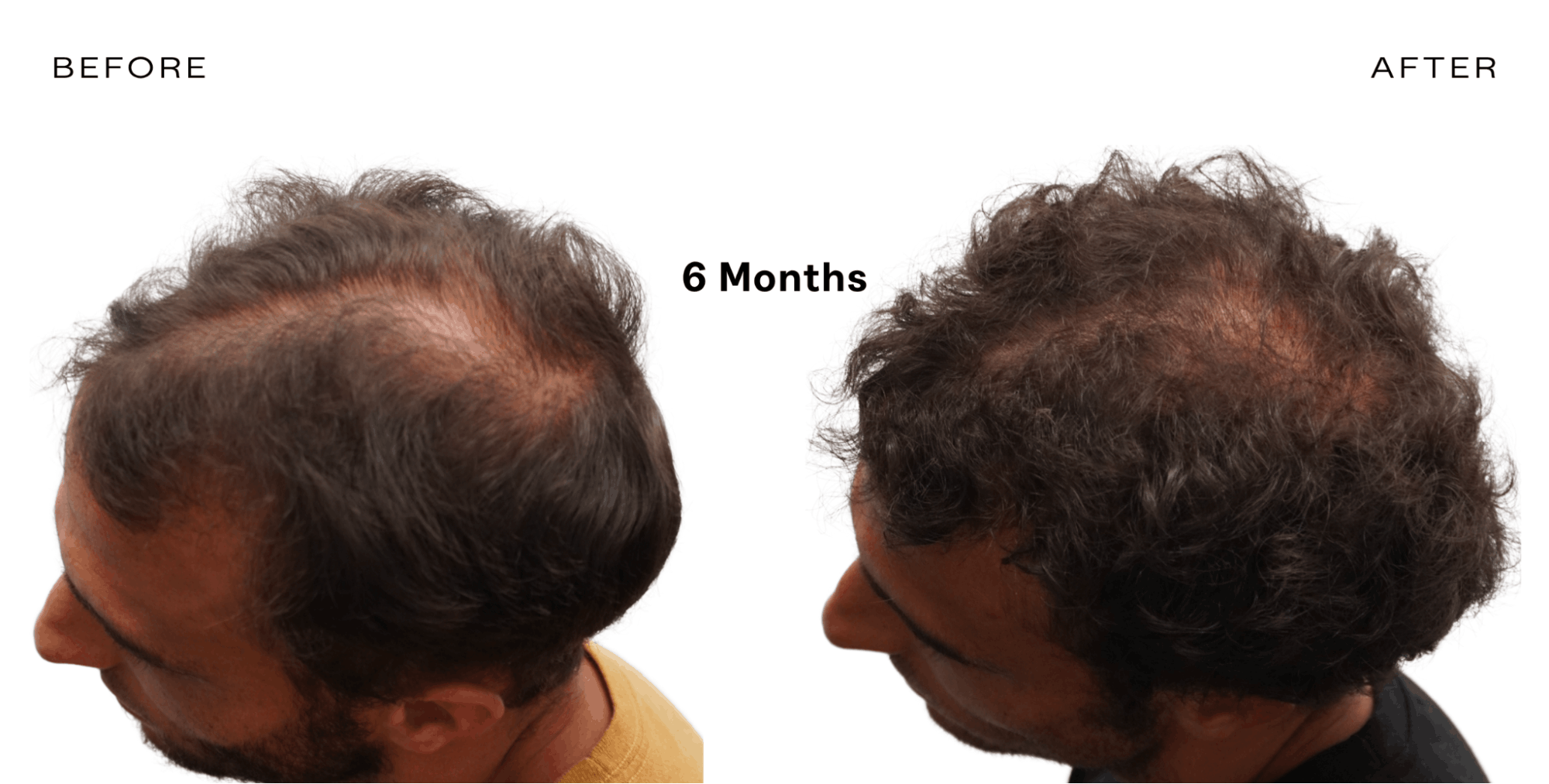 red light therapy hair loss results