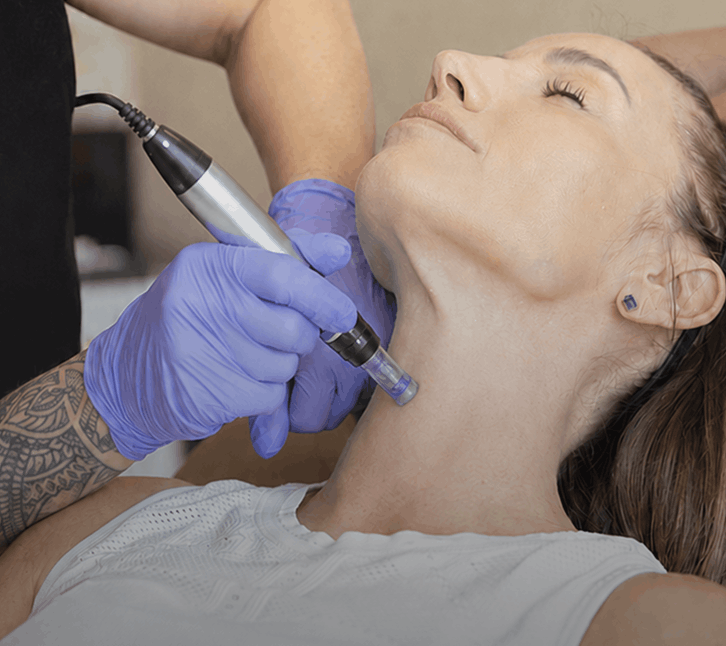 Medical Microneedling for Skin in Scottsdale