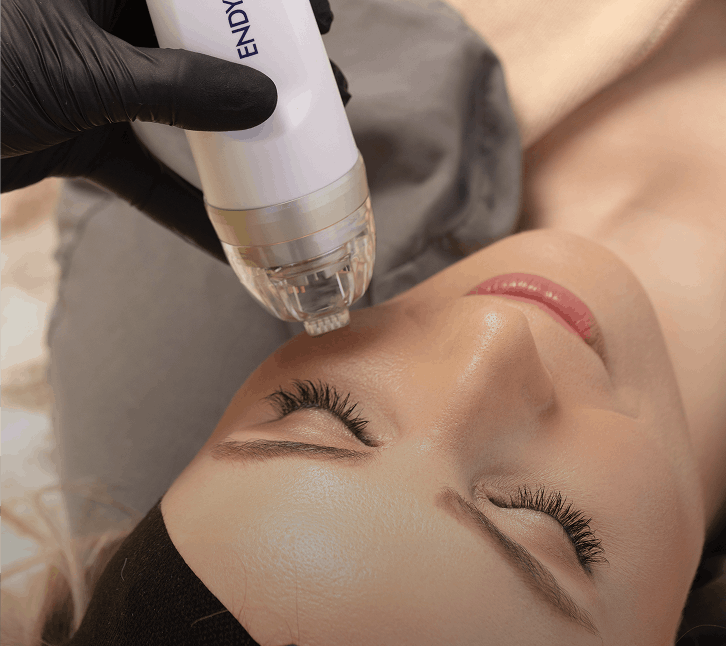 rf-microneedling-treatment scottsdale