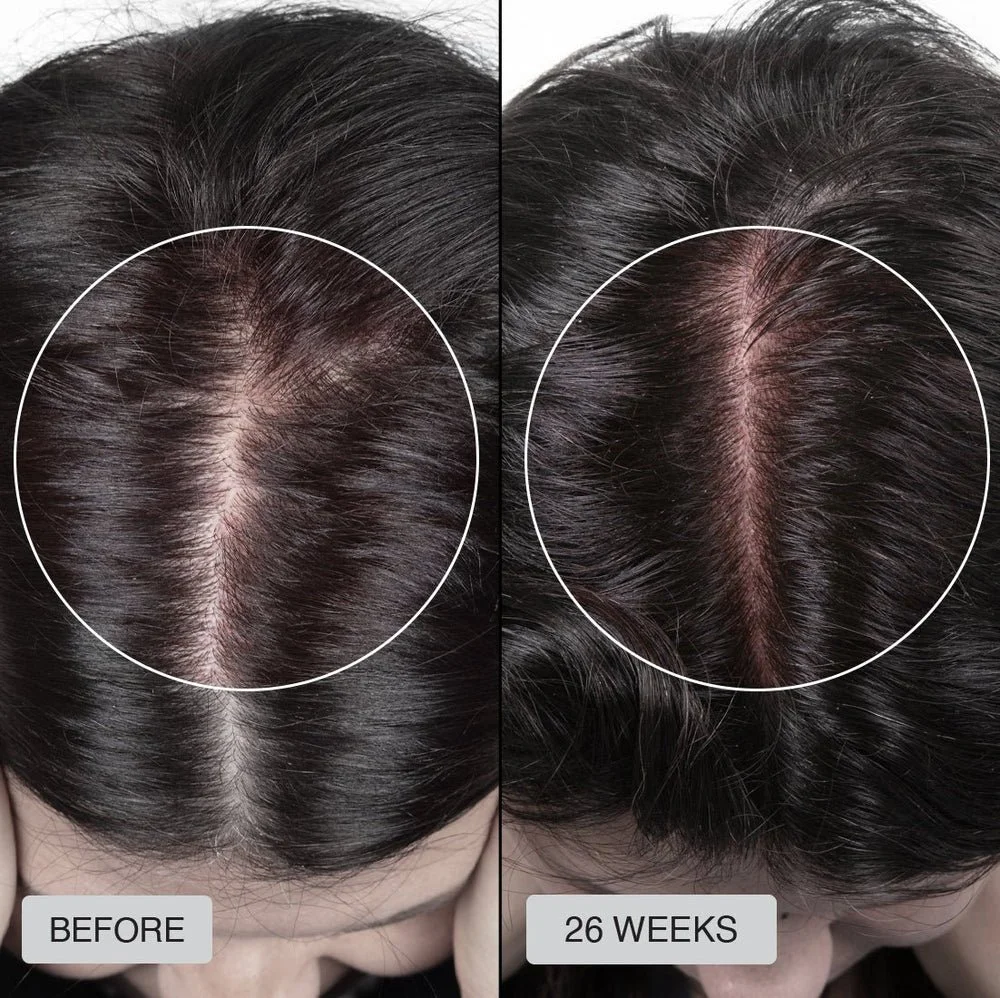 Best Laser Cap For Hair Loss