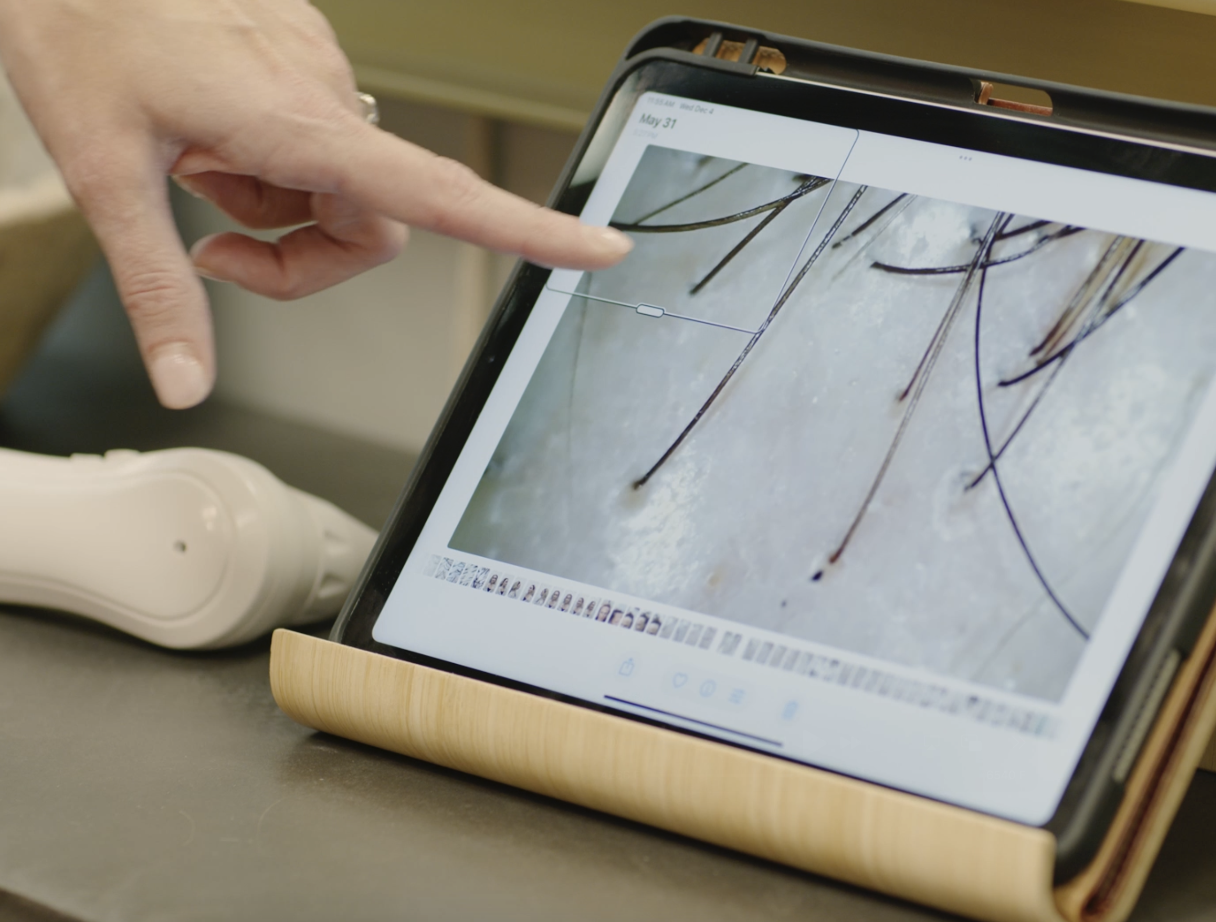 a trichologist looking at a zoomed in hair follicle at a hair loss appointment