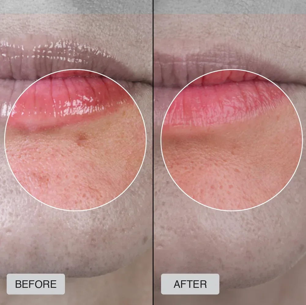 Fine Lines  Red Light therapy helps reduce fine lines, wrinkles and dark spots.