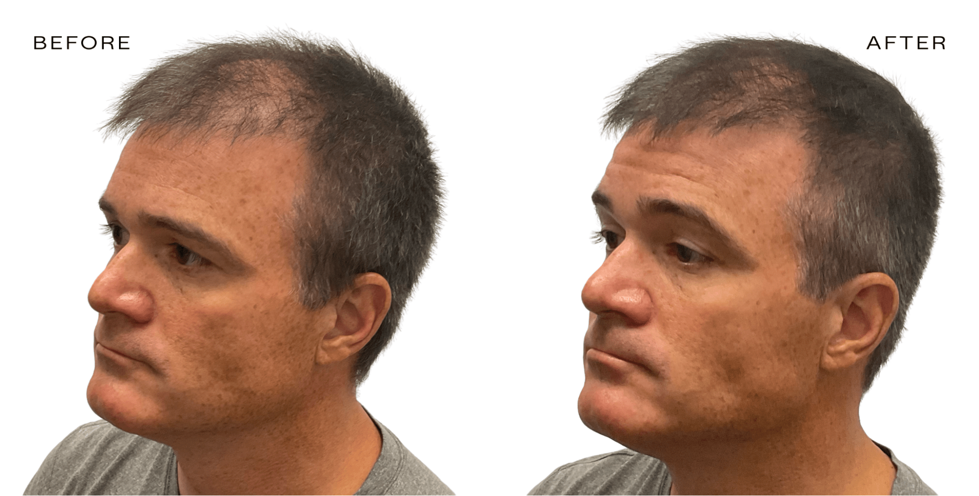 male balding hair loss myth
