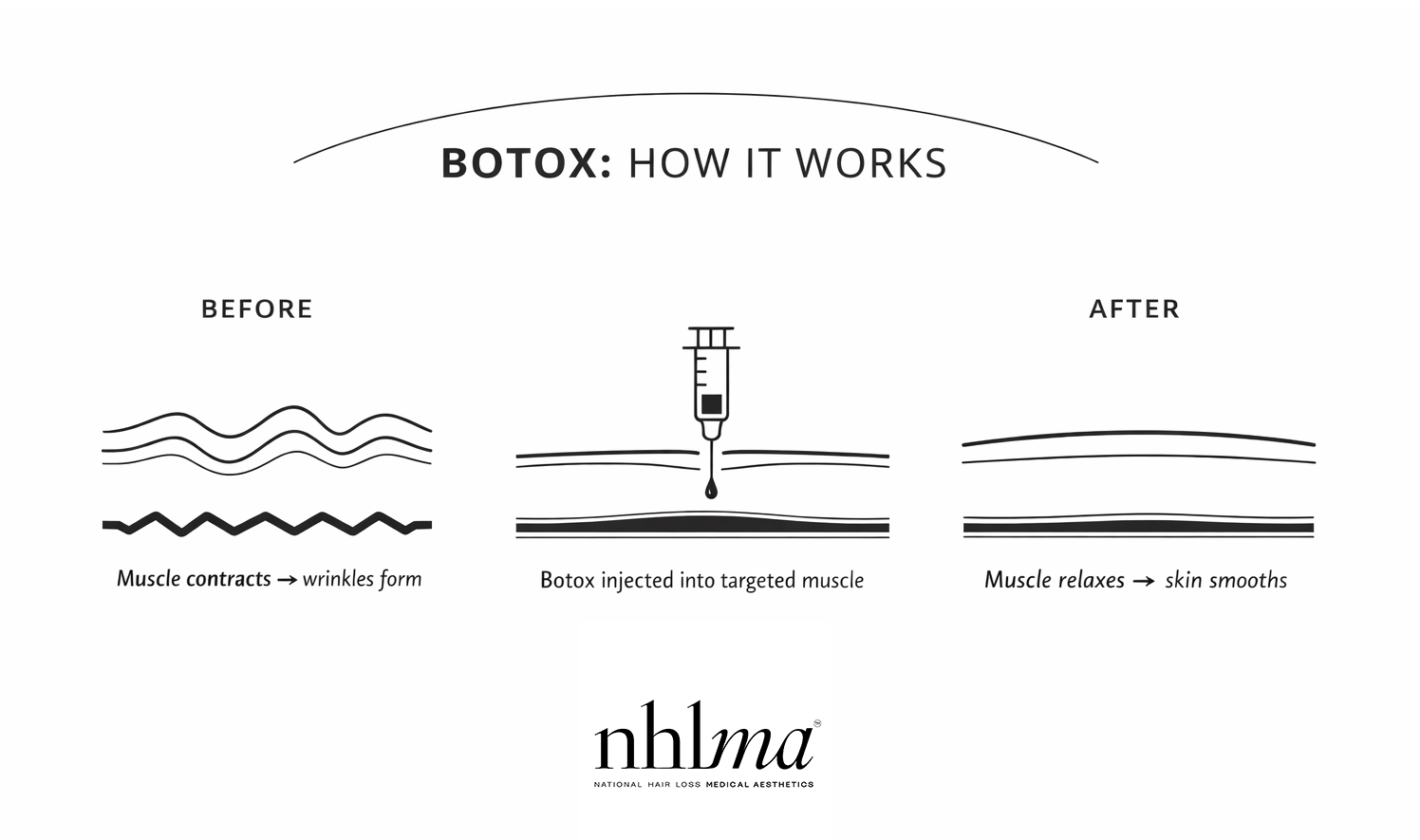 how botox works at NHLMA in scottsdale