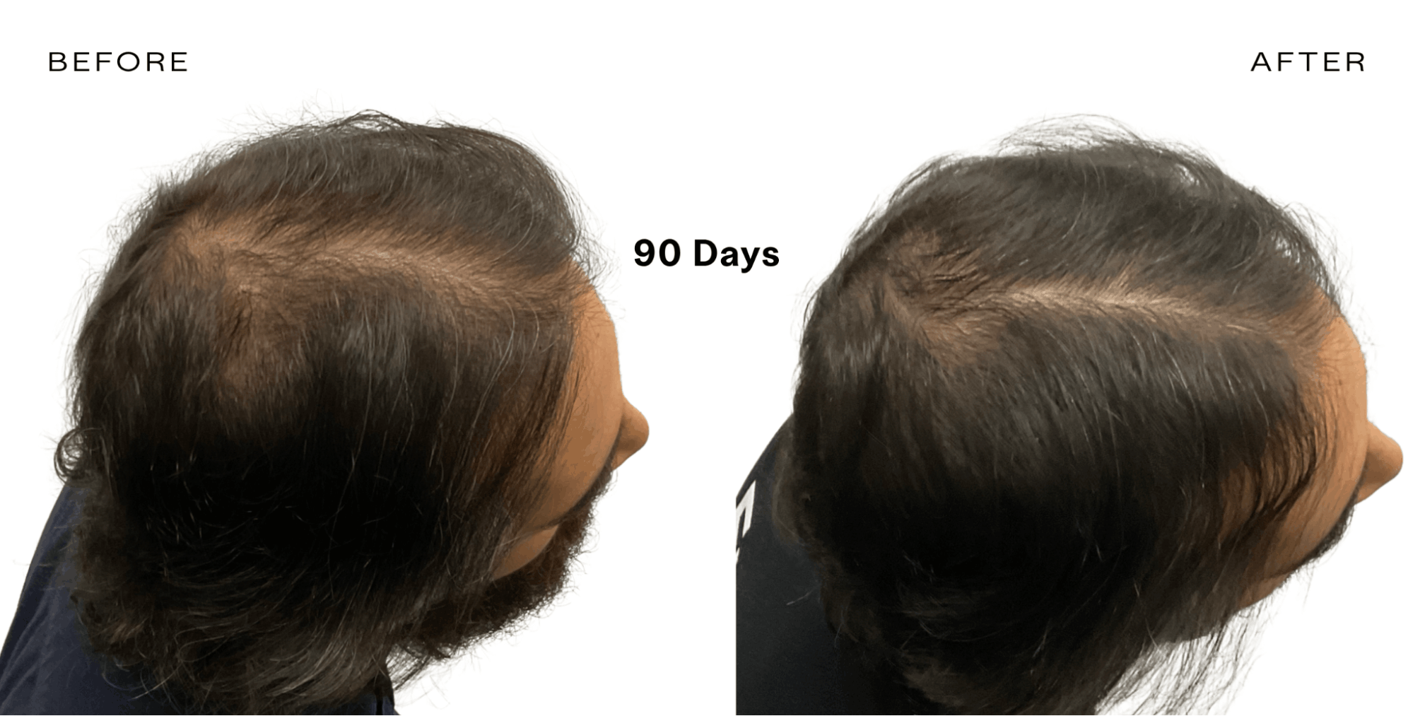 male finasteride hair growth before and after
