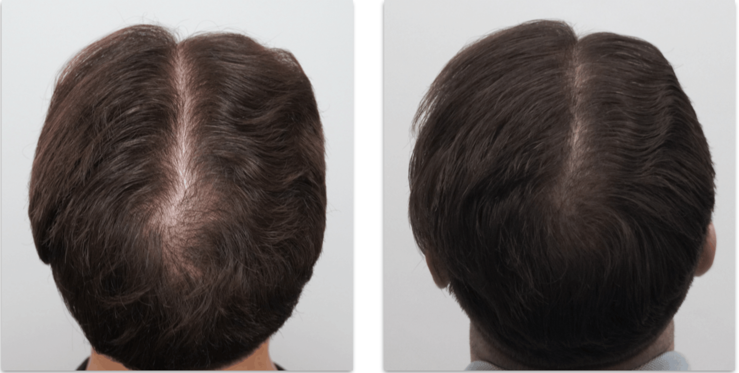 best non surgical hair loss solutions for men