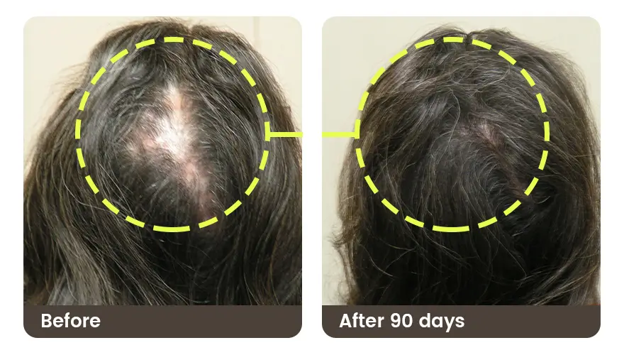 best topical melatonin serum for hair loss before and after