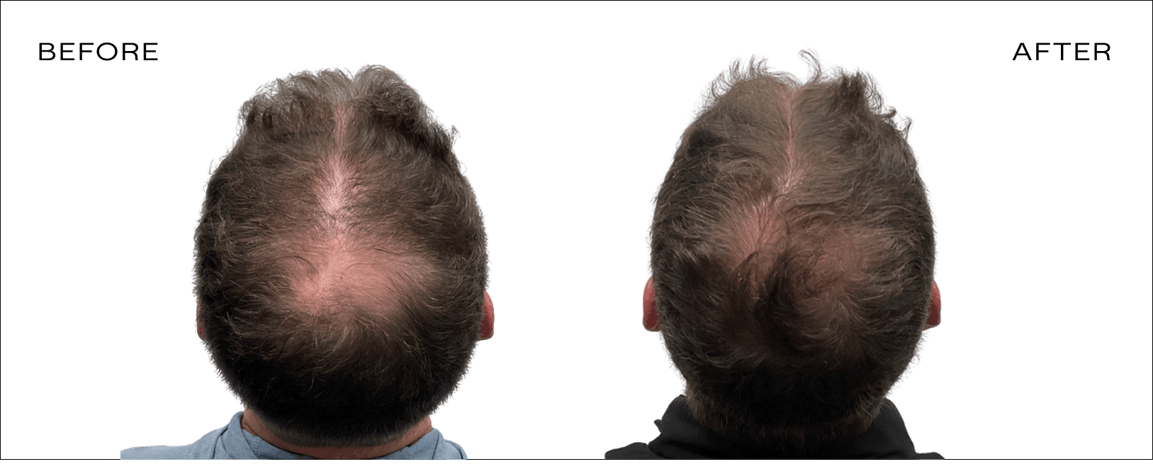 before and after leiah hair loss consultant
