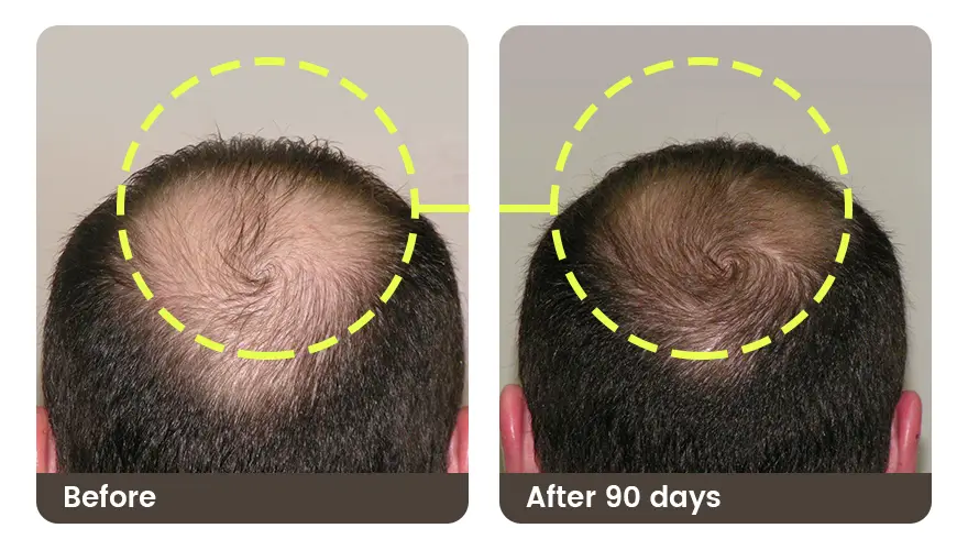 topical melatonin for hair loss