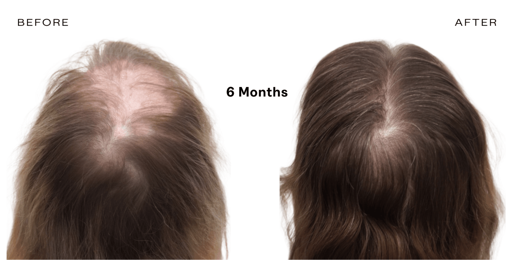 red light therapy for hair loss before and after