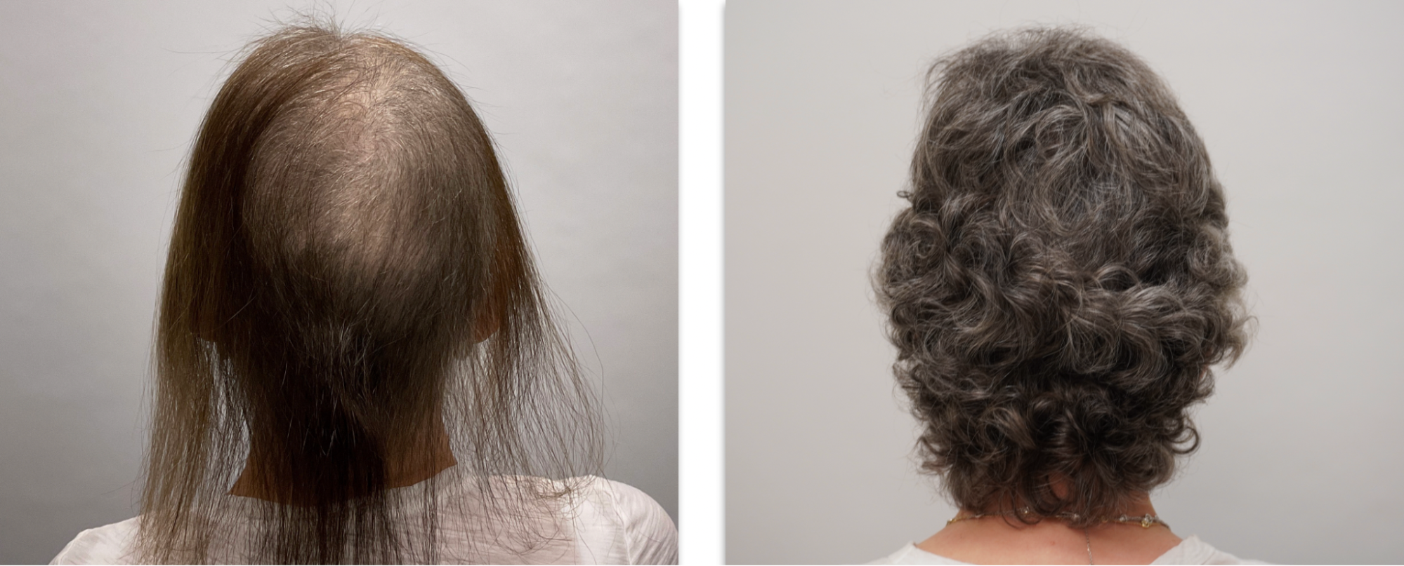 telogen effluvium hair loss women