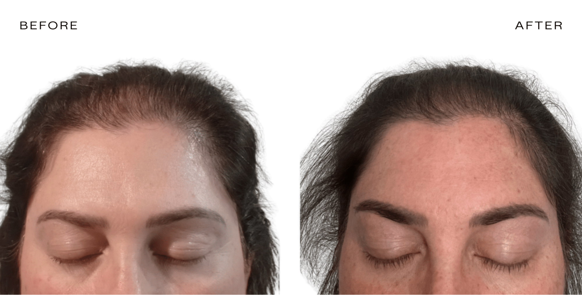 hair thinning female before and after