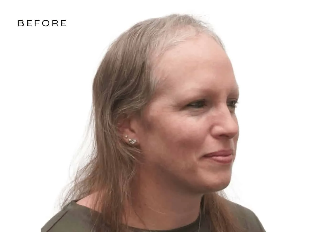 female before and after hair loss