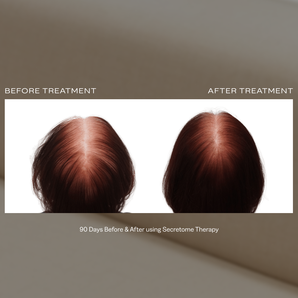 secretome hair restoration package.png