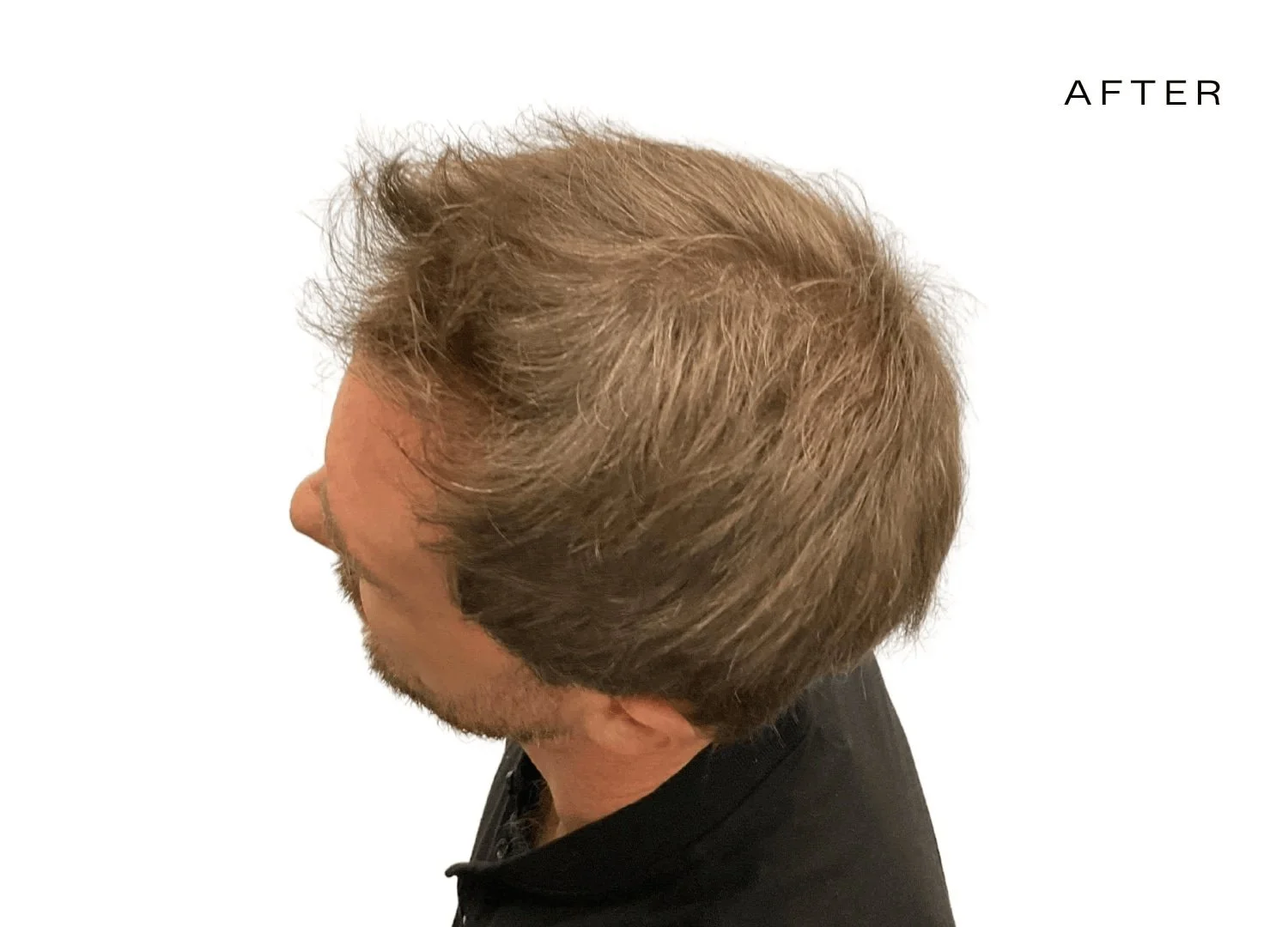male hair growth treatment after