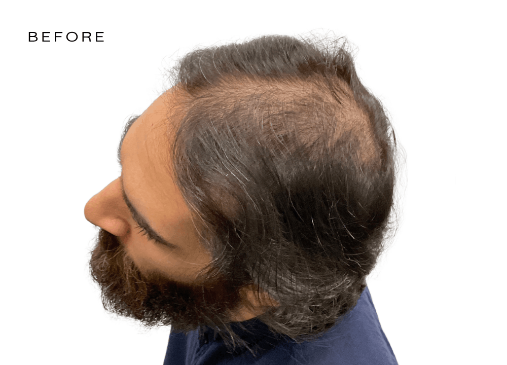 male before and after hair loss