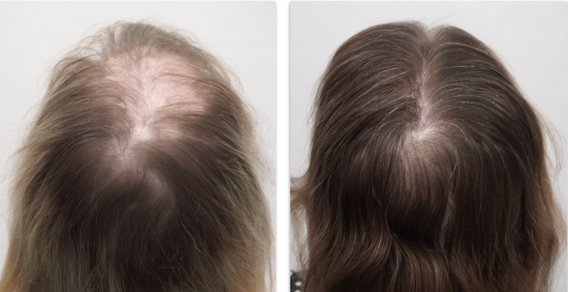 NHLMA Patient 6 Month Before and After hair growth