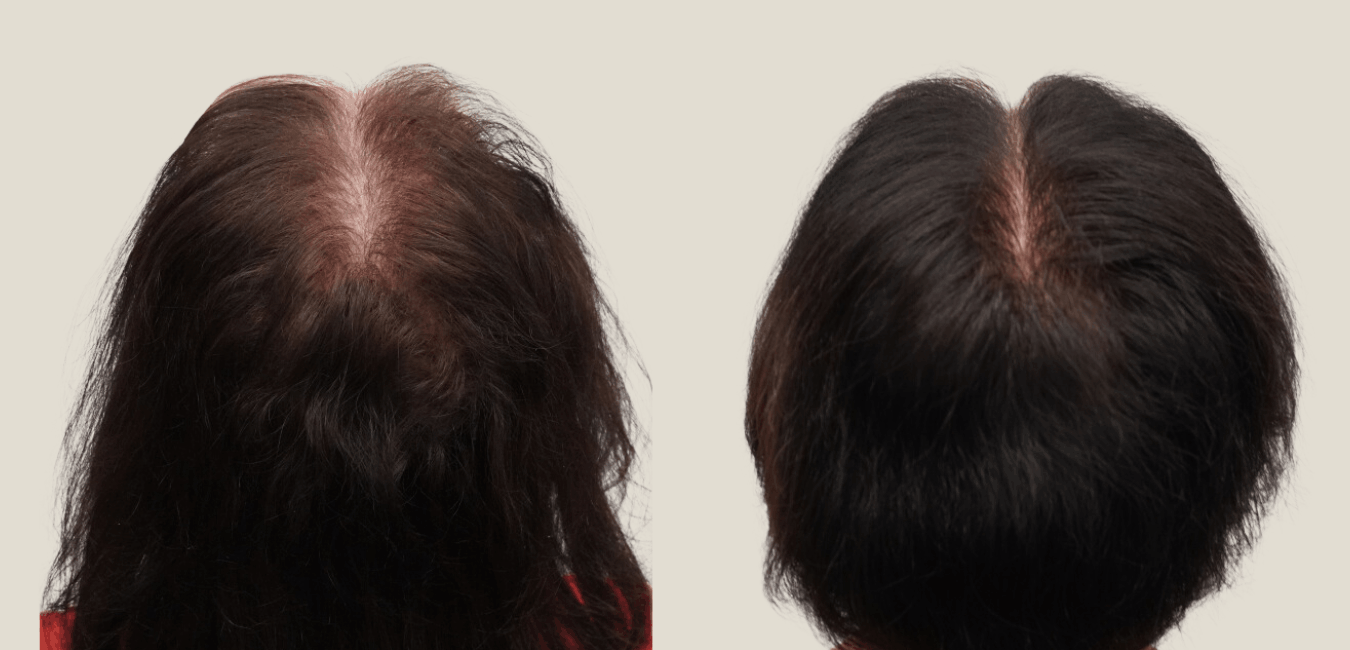 exosome therapy before and after for hair loss