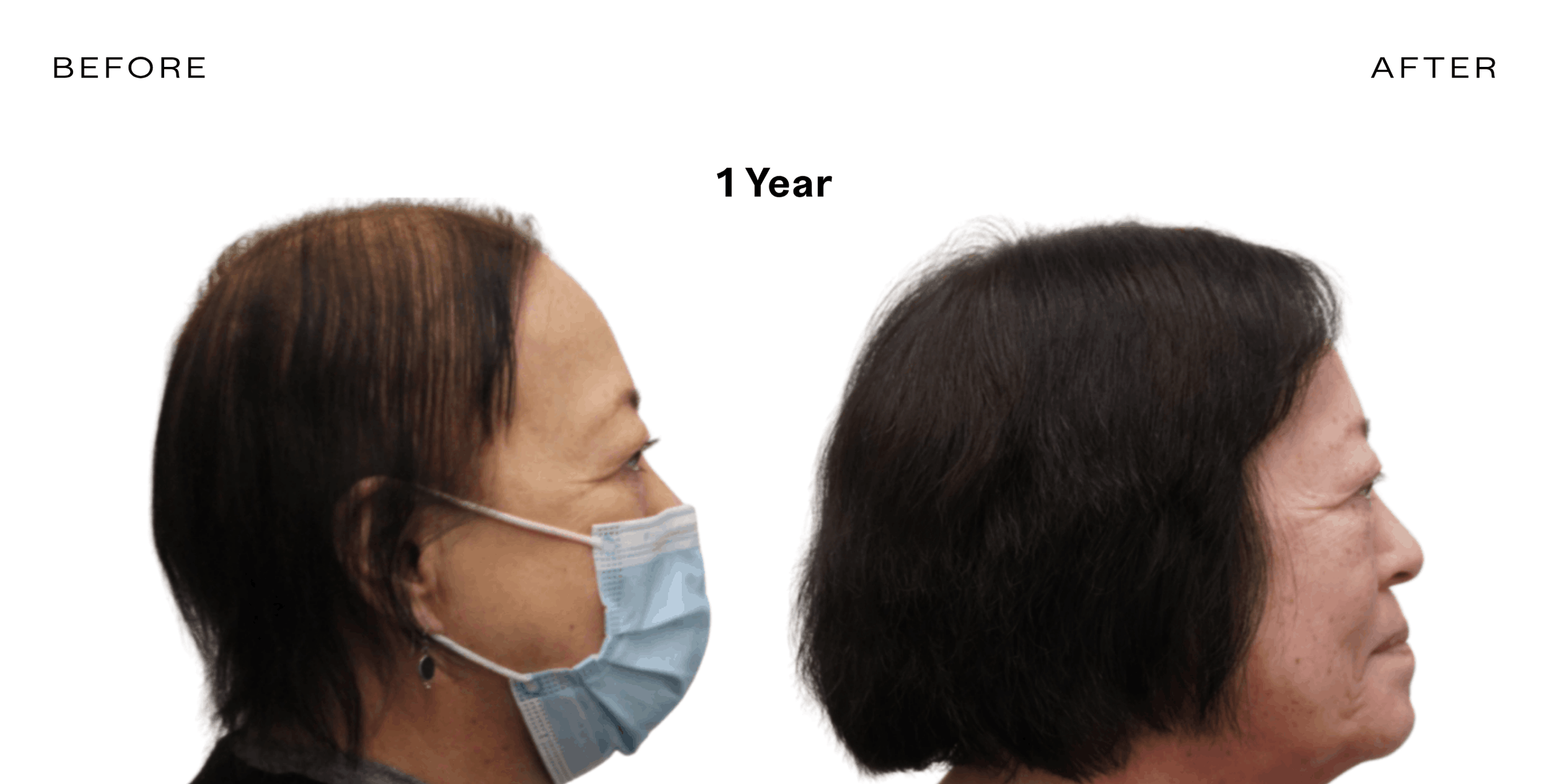 exosome therapy for hair loss