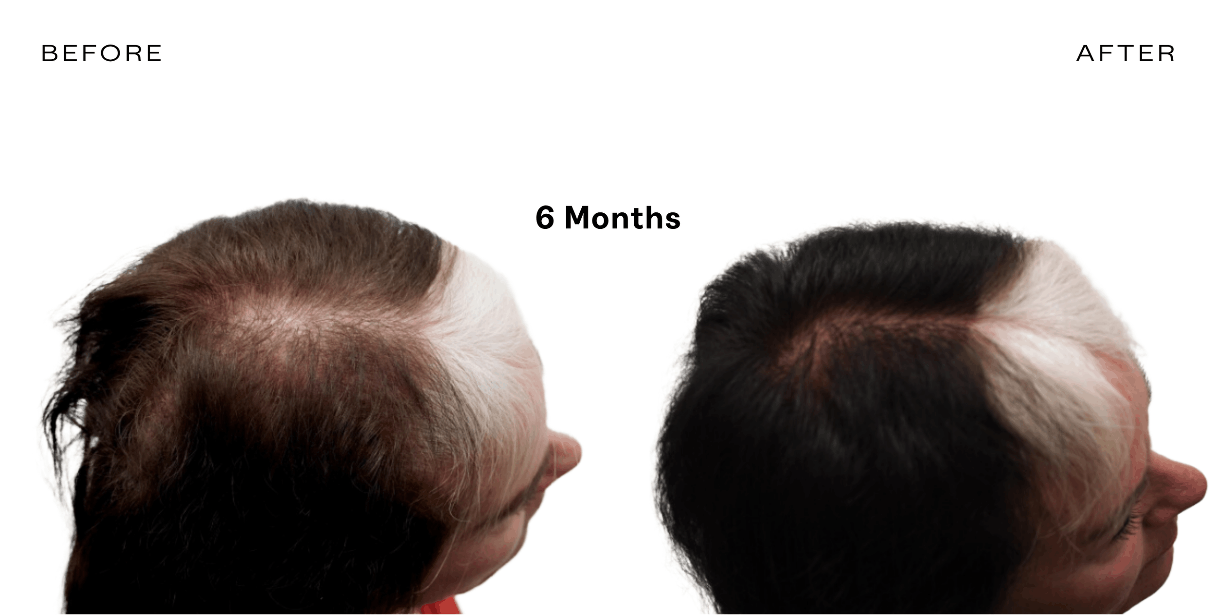 exosome therapy for hair loss