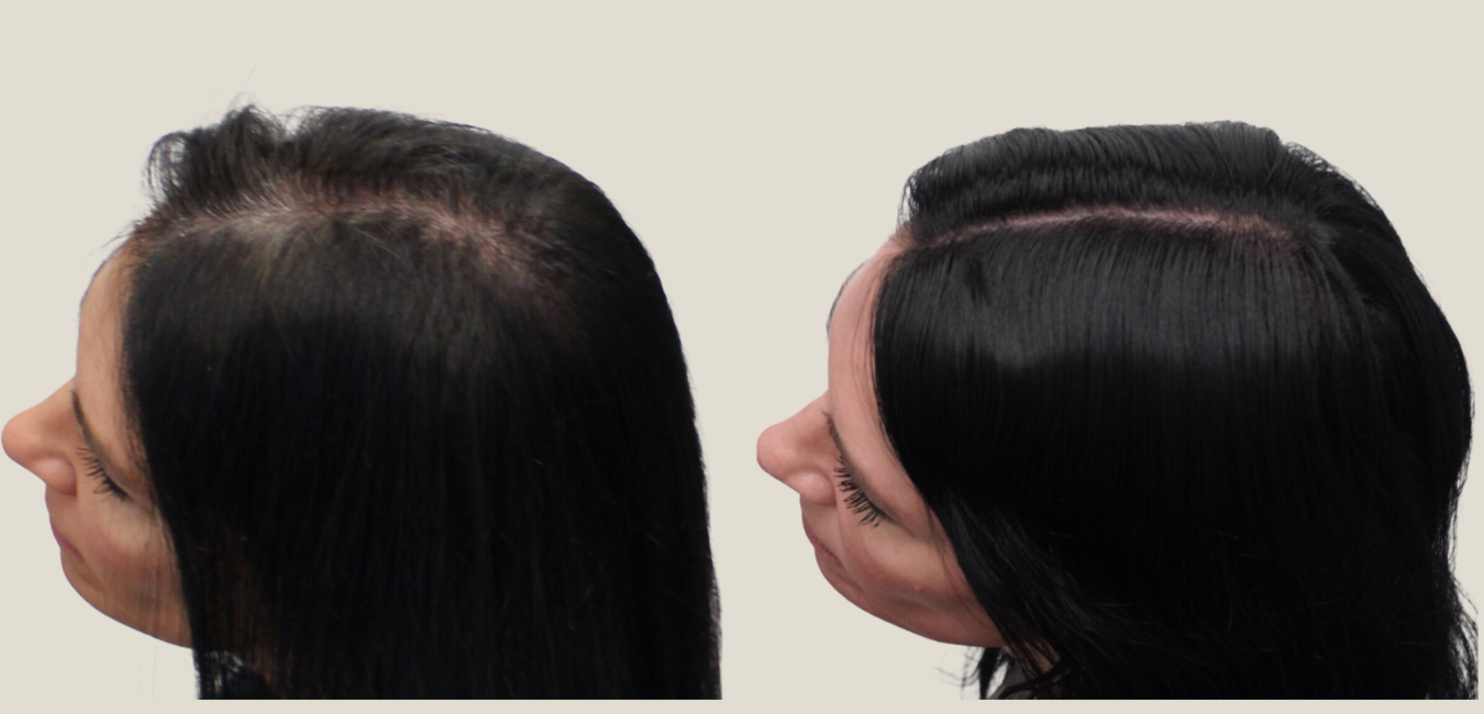 before and after female hair loss telogen effluvium