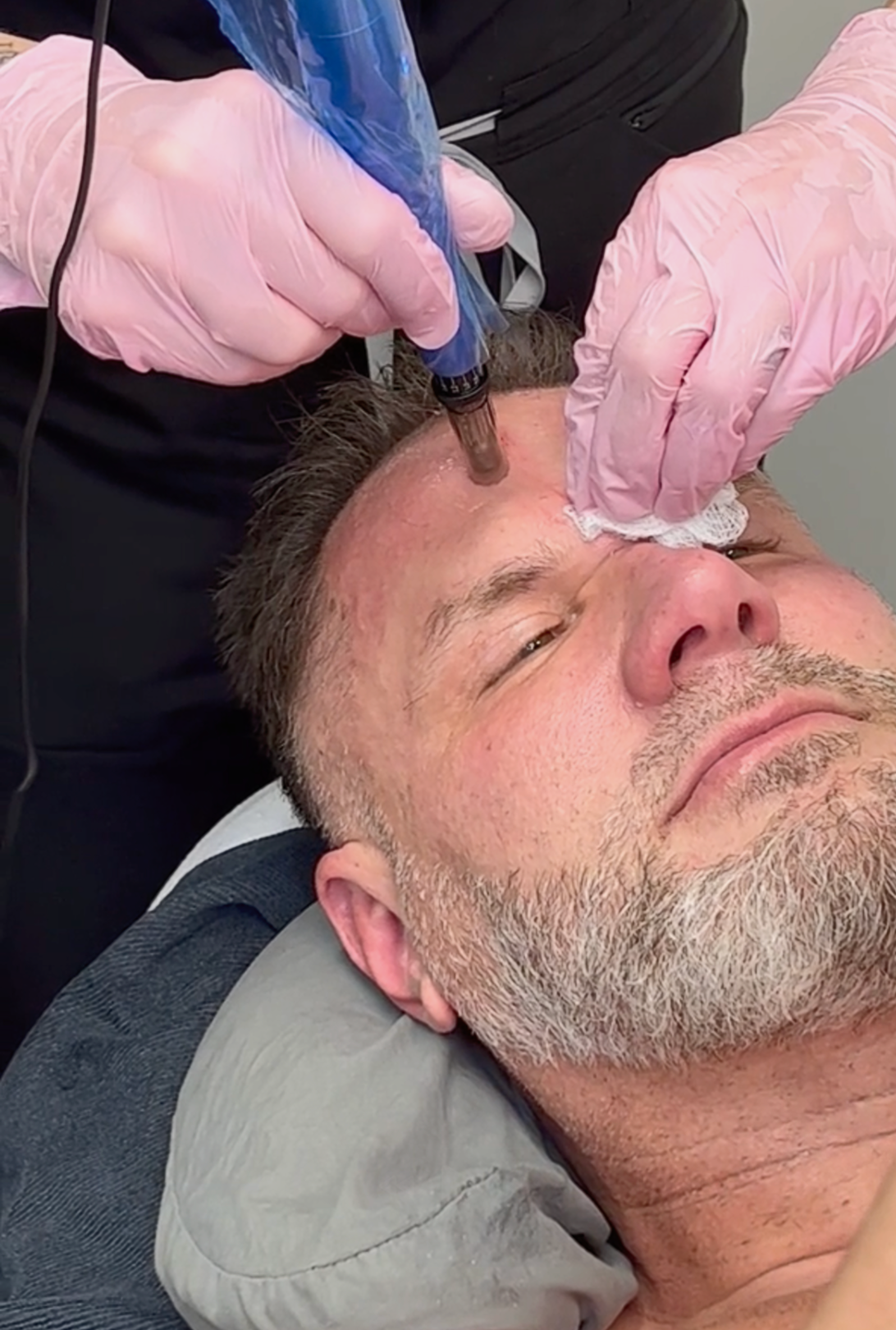 microneedling for skin facial.png