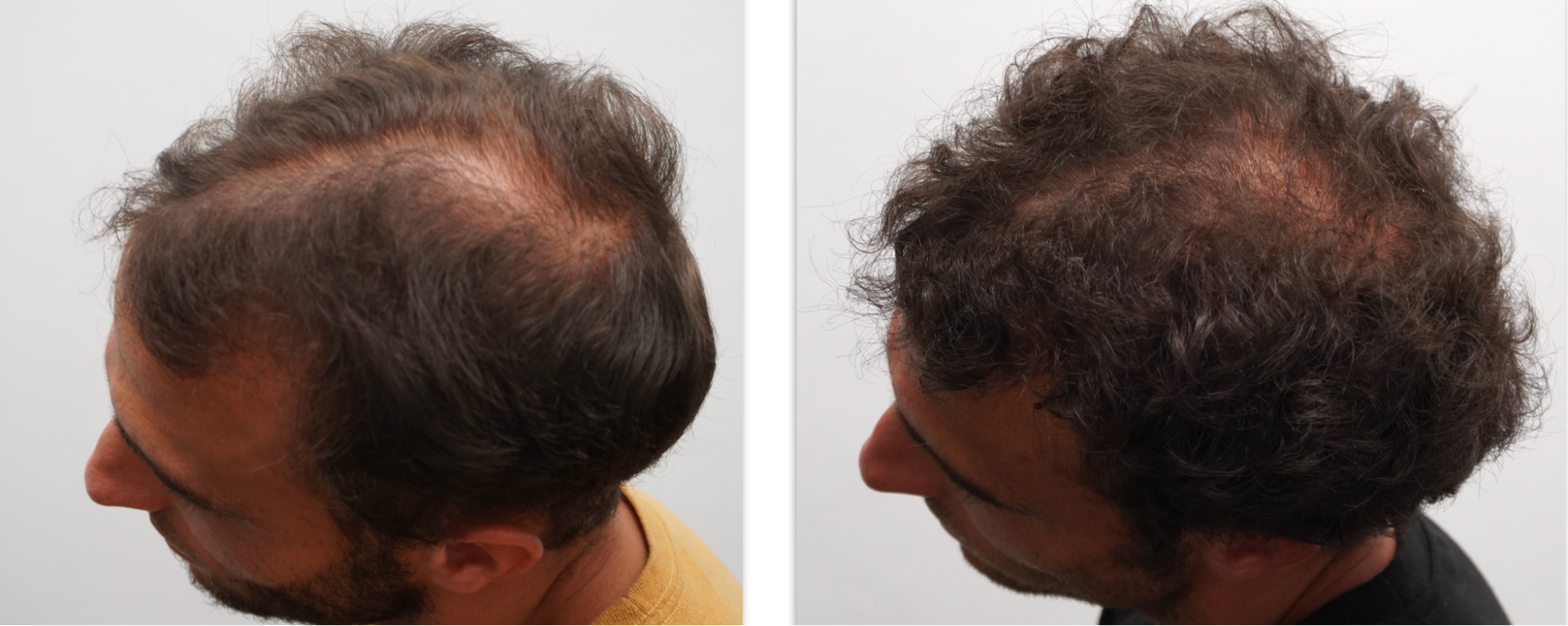 before and after hair loss treatment scottsdale