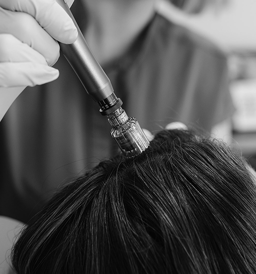 Scalp Microneedling with Growth Factors