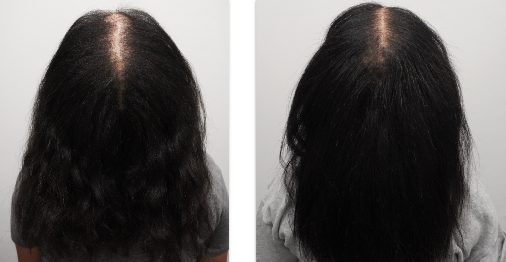 alopecia hair loss in women nhlma