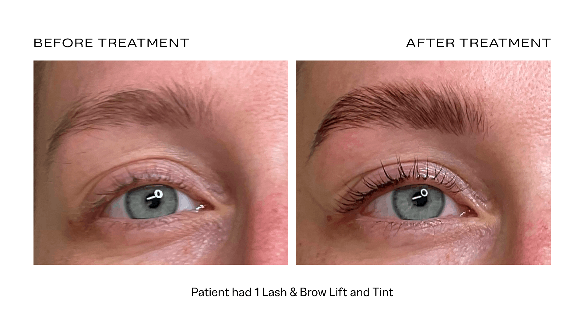 before after lash brow lift