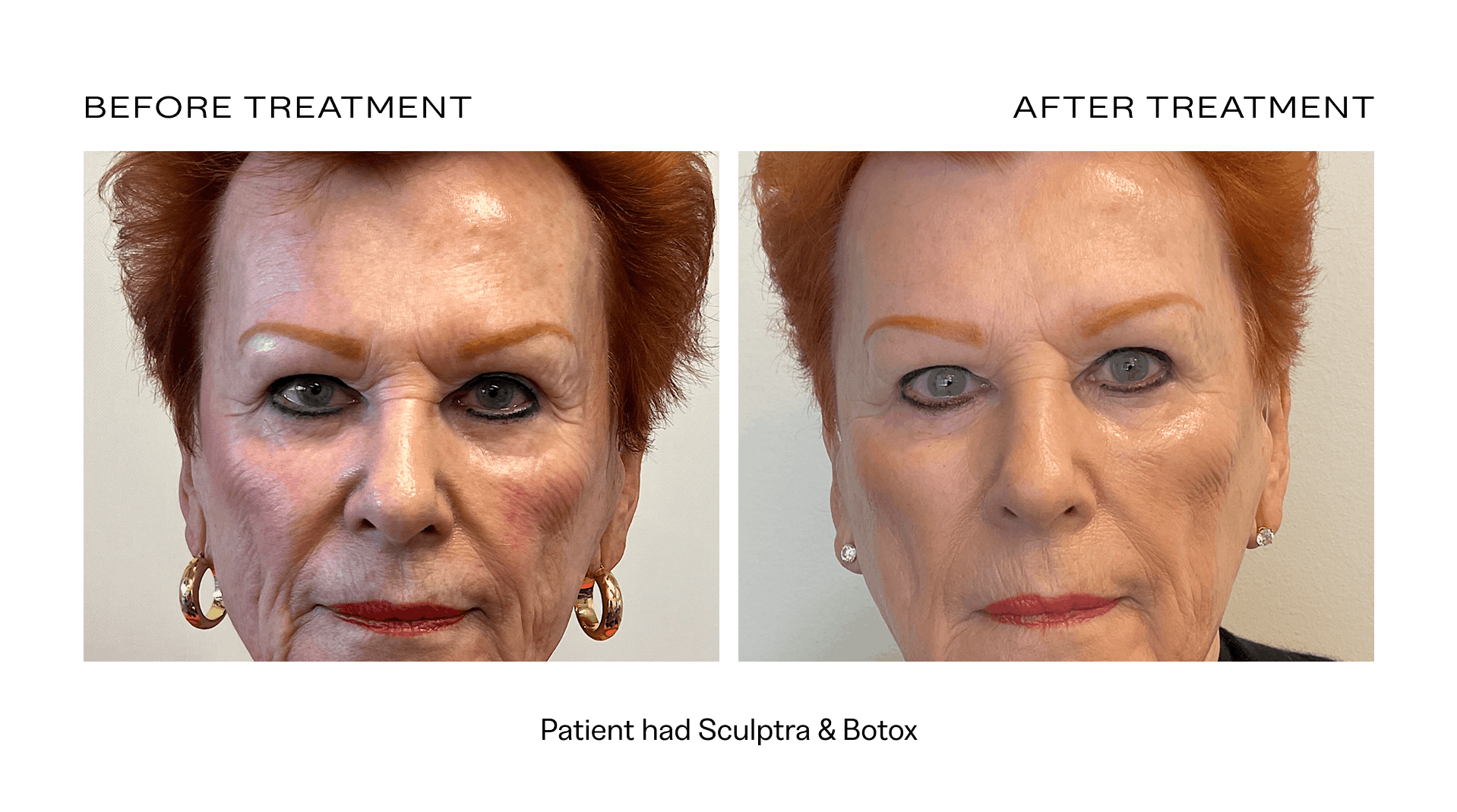 before after botox filler scottsdale