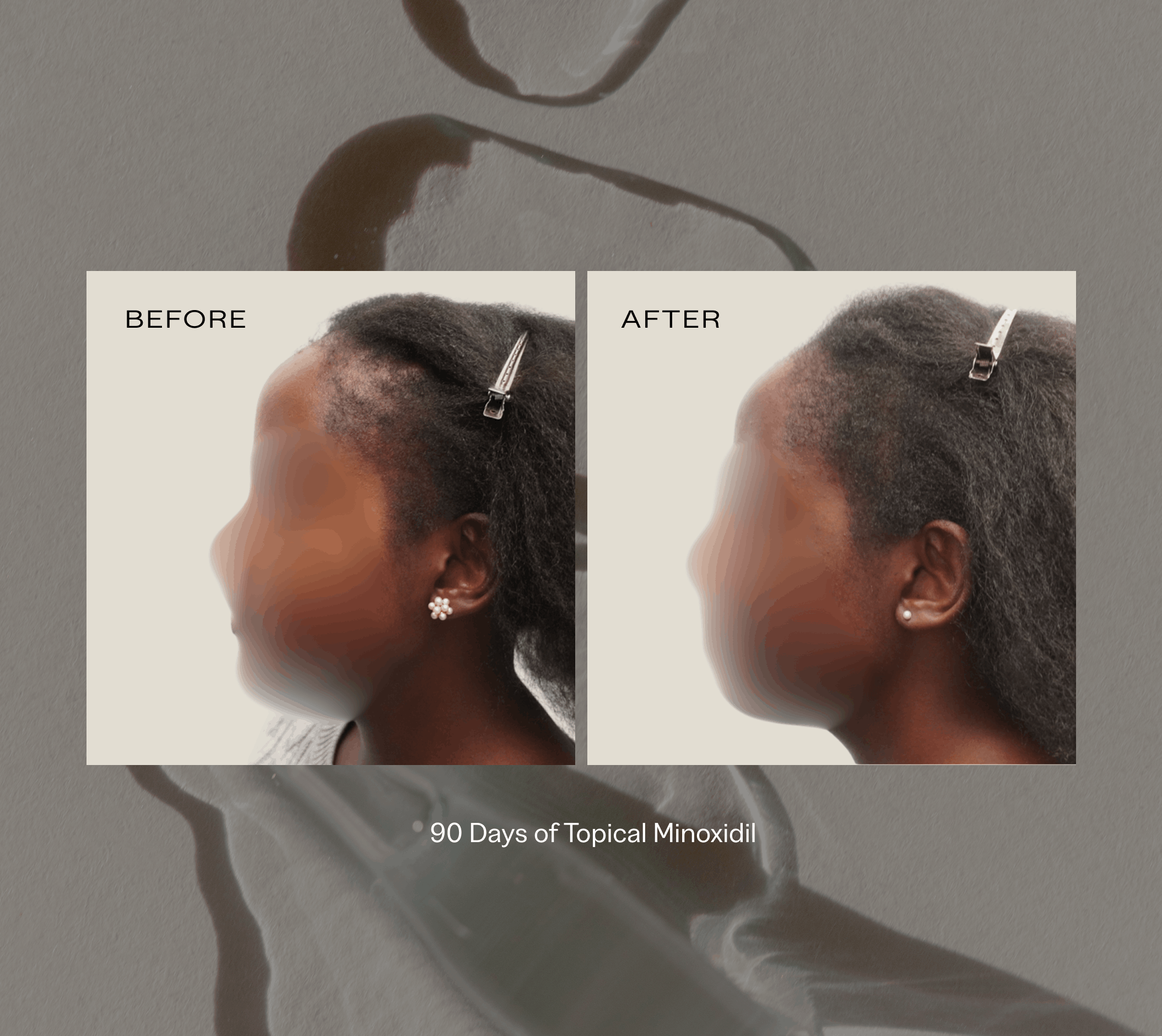 Topical Solution for Hair Loss | Prescription Hair Regrowth Treatment